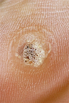 Stampe di Una verruca (o plantar warts), una piccola crescita benigna nella pelle causata da un'infezione virale Immagini datate 2004 novembre: Verruca