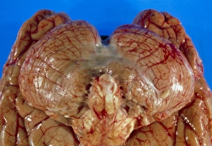 Stampe di L'arachnocitoide è una malattia infettiva che colpisce il cervello e la medulla spinale. La parte inferiore del cerebro è vista (a sinistra) Immagini datate 2003 settembre: Vista dell'undersuperficie del cervello con meningoite