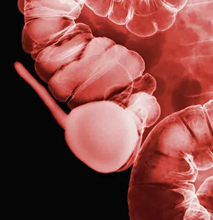 Stampe di Un'appendice sana. Raggio X colorato dell'appendice e del colo (intestino cavo). L'appendice (a sinistra) è un tubetto sottile a forma di dita, lungo circa 9 centimetri negli adulti Immagini datate 2012 aprile: Riflessione dell'appendice con raggi X