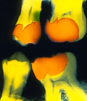 Dental X Ray Stampe: X-ray of teeth