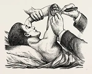 Medical Equipment History Stampe: excision of the elbow, the clearing of the humerus, medical equipment, surgical instrument