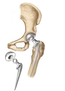 Hip Replacement Surgery Stampe: Detail of hip replacemnt