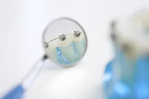 Dental Model Stampe: Detail of a model of teeth with braces