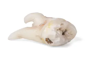 Pulled Wisdom Tooth Stampe: Pulled wisdom tooth, tooth, carious
