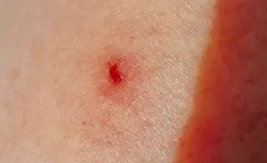 Freshwater Fish Habitat Stampe: Tick bite