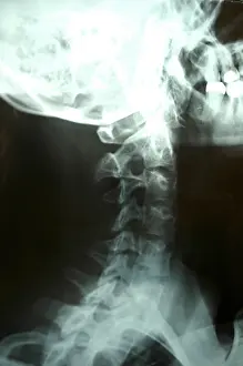 Cervical Vertebrae Stampe: X-ray