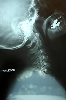 Cervical Vertebrae Stampe: X-ray