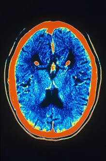 Human Brain Anatomy Stampe: Brain, CT Scan