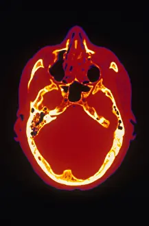 Computed Tomography Scans Stampe: Head, CT Scan