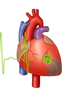 Medical Anatomy Drawing Stampe: Heart Attack