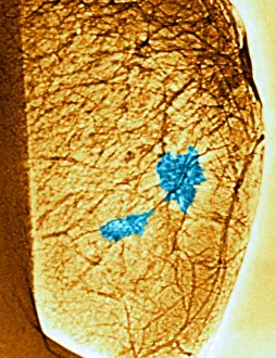 Medical Imaging Techniques Stampe: Mammogram