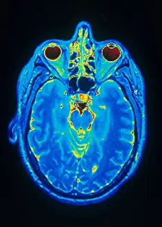 Normal Brain Structure Stampe: MRI of Brain
