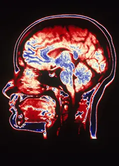 Normal Brain Anatomy Stampe: MRI of Head