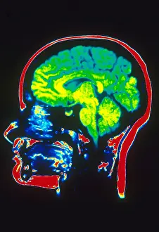 Normal Brain Structure Stampe: MRI of Head