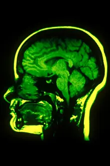 Normal Brain Structure Stampe: MRI of Head