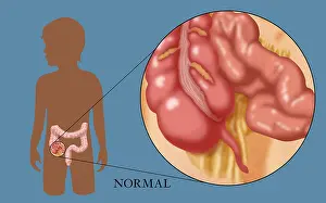 Human Digestive System Illustration Stampe: Normal Appendix