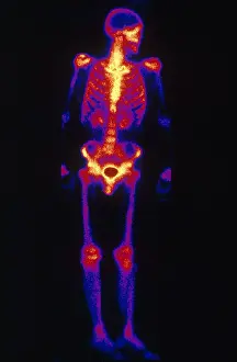 Medical Imaging Techniques Stampe: Normal Bone Scan