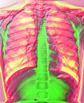 Medical Computer Graphics Stampe: A normal chest X-ray