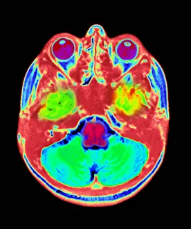 Normal Brain Anatomy Stampe: Normal MRI