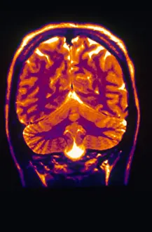 Normal Brain Anatomy Stampe: Normal MRI of Brain
