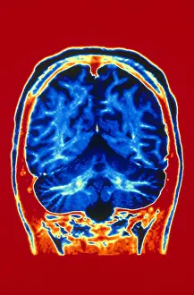 Magnetic Resonance Imaging (MRI) Stampe: Normal MRI of Brain