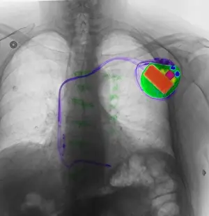 Human Anatomy Stampe: Pacemaker