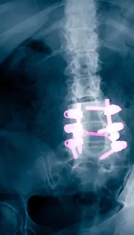Vertebral Column Anatomy Stampe: Spinal Fusion