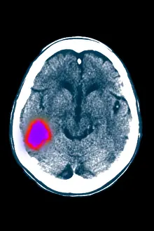 Computed Tomography Scans Stampe: Temporal lobe stroke